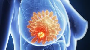 Καρκίνος του μαστού: Όλα όσα πρέπει να γνωρίζετε για την αποκατάσταση μετά από μαστεκτομή